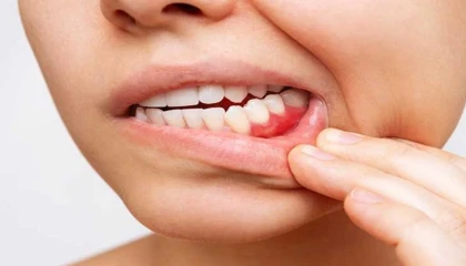 Diş eti çekilmesi diş kaybı ile sonuçlanabilir!