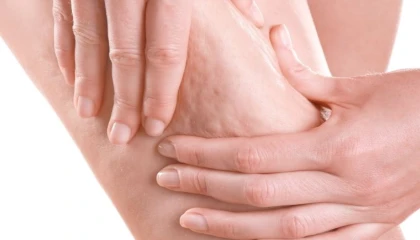 Prof. Dr. Karacalar’dan selülit uyarısı: Portakal kabuğu görüntüsü basit sorun değil!