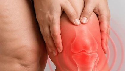 Diz biyomekaniğini bozan süreç: Lipödem