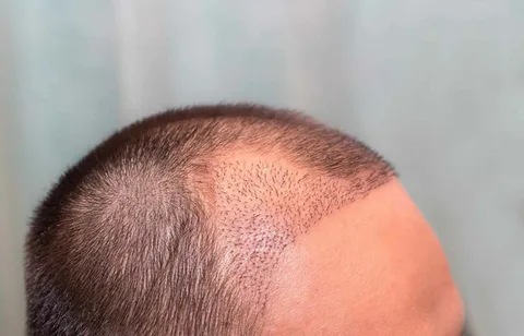 Saç ekimi ve estetikte kaçak risk alarmı